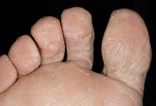 A láb candidiasis