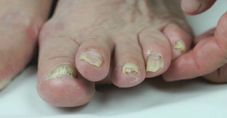 Onchomycosis