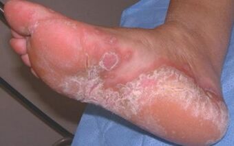A láb akut dermatomycosis