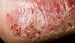 Dermatomycosis