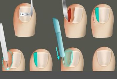 A köröm eltávolítása a lábakon egy gomba jelenlétében