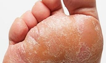 A gomba jelei és tünetei a lábakon