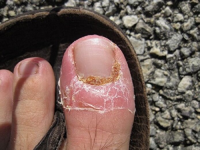 a körmök és a lábujjak bőrének károsodása gombás fertőzés következtében